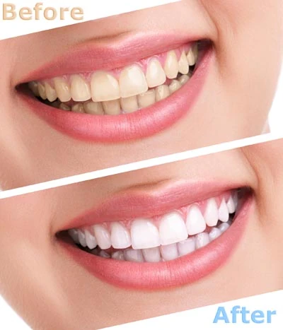 teeth whitening Midlothian VA